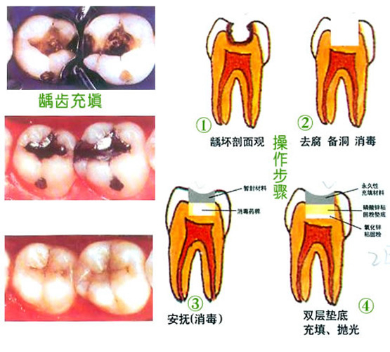 牙齿龋坏结构图图片
