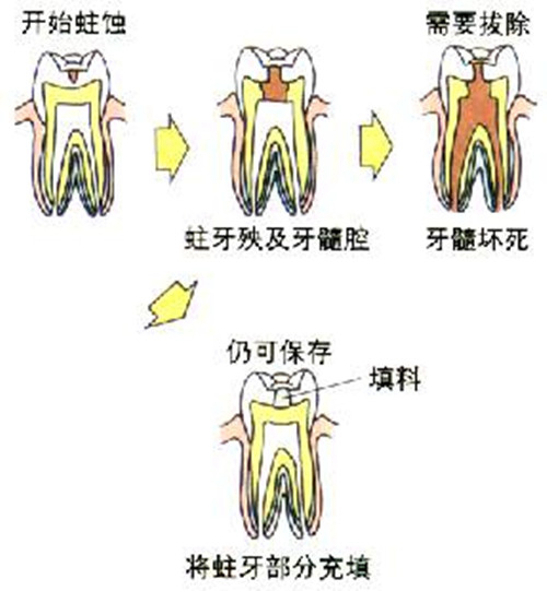 齲齒過程圖片