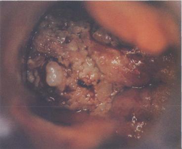 妇科外面的疱疹图图片