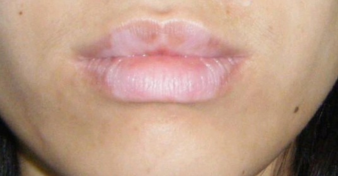 嘴唇白斑早期图片图片
