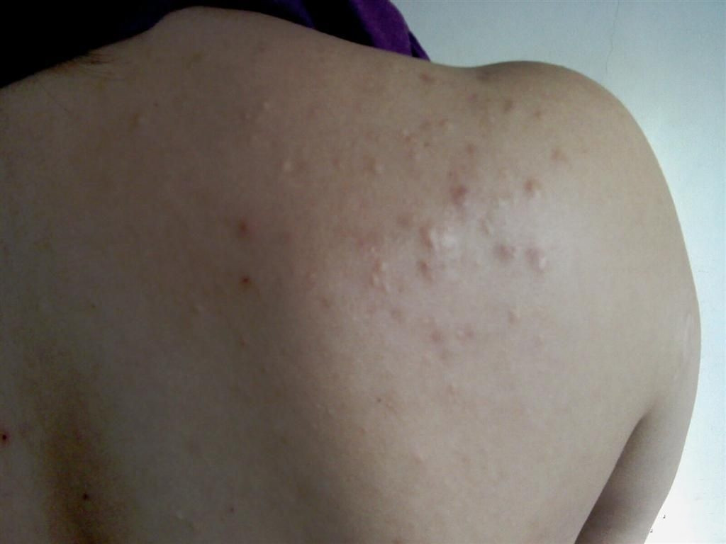 丘疹性痤疮状图片