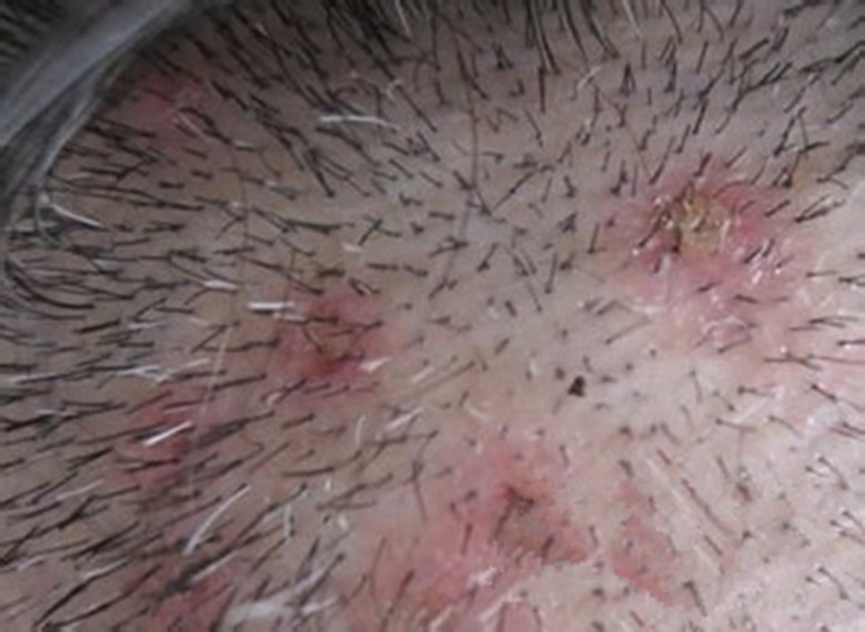 头上长痤疮的图片