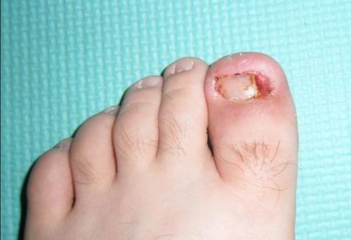 治疗甲沟炎有什么办法呢(1)