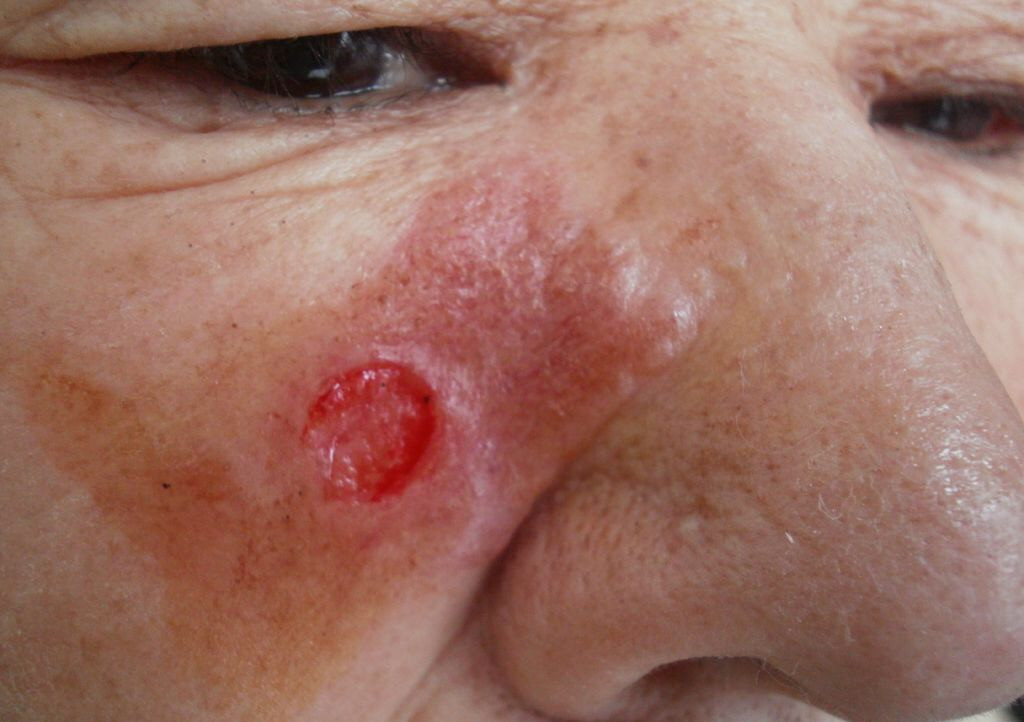 溃疡性皮肤结核病图片