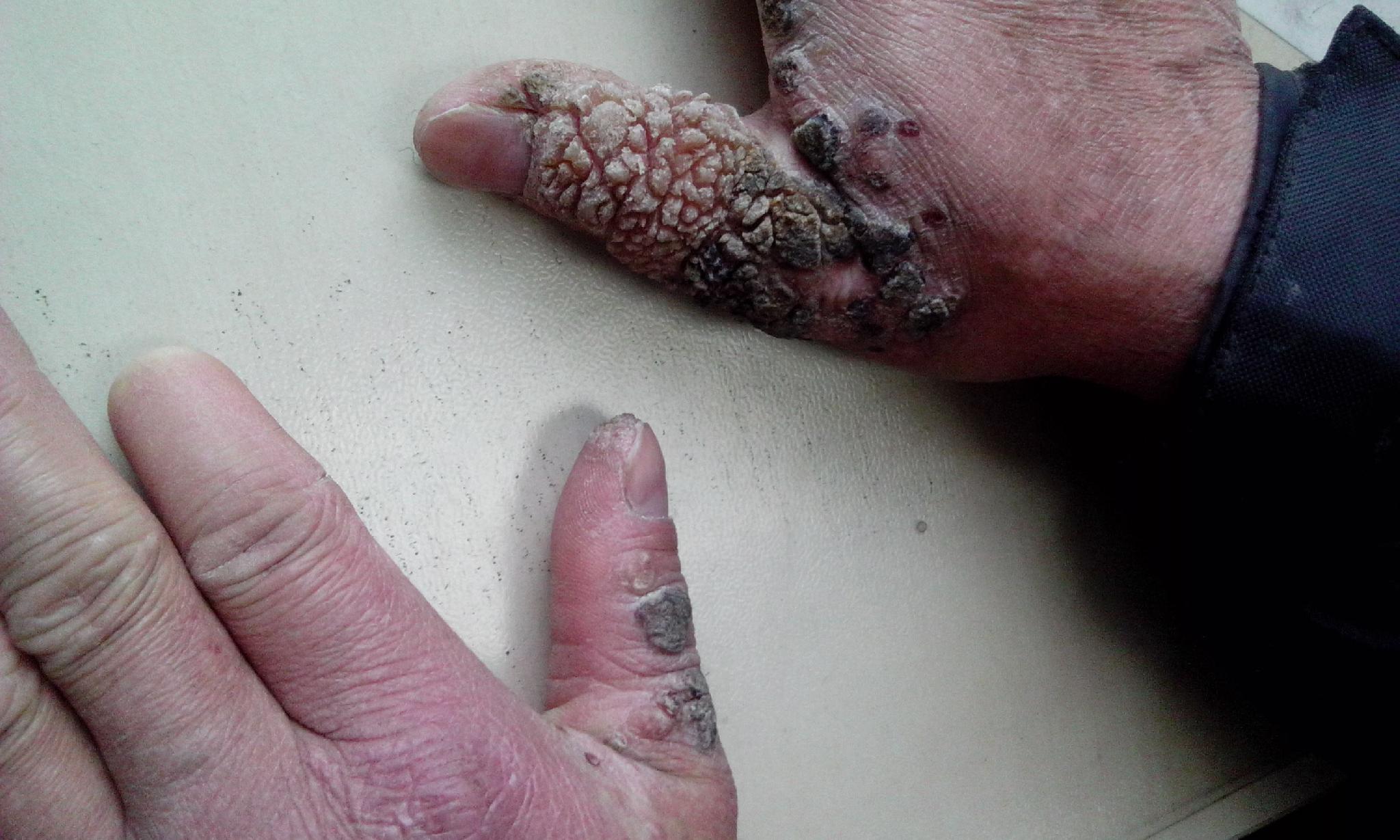 皮肤结核病图片_皮肤结核病症状表现图片大全_有来医生