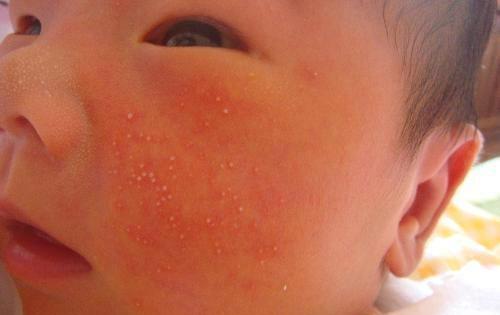  面部湿疹怎么治疗