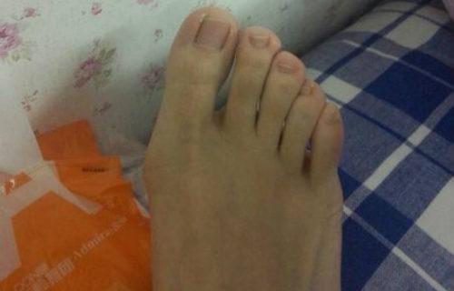 脚趾外翻怎么办