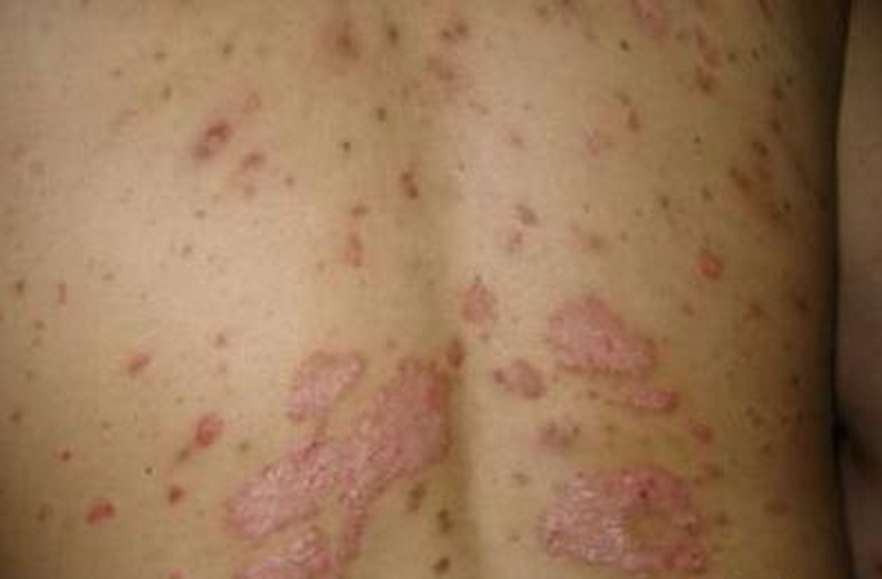 背部神经性皮炎图片