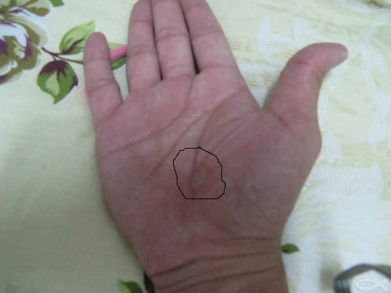 手掌上长了个鸡眼图片