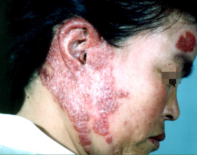 皮肤感染 艾滋病人图片