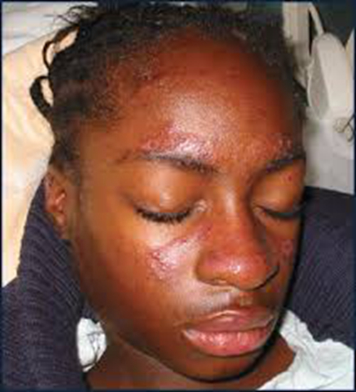 女性艾滋病面部皮疹症状图片