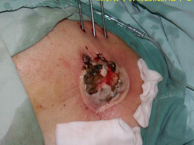 人类乳头瘤感染图片