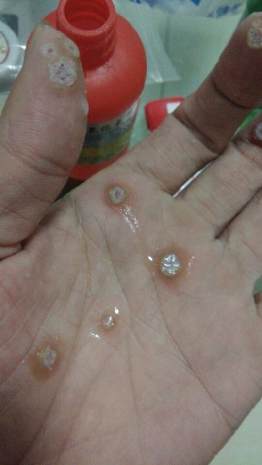 手心的跖疣图片