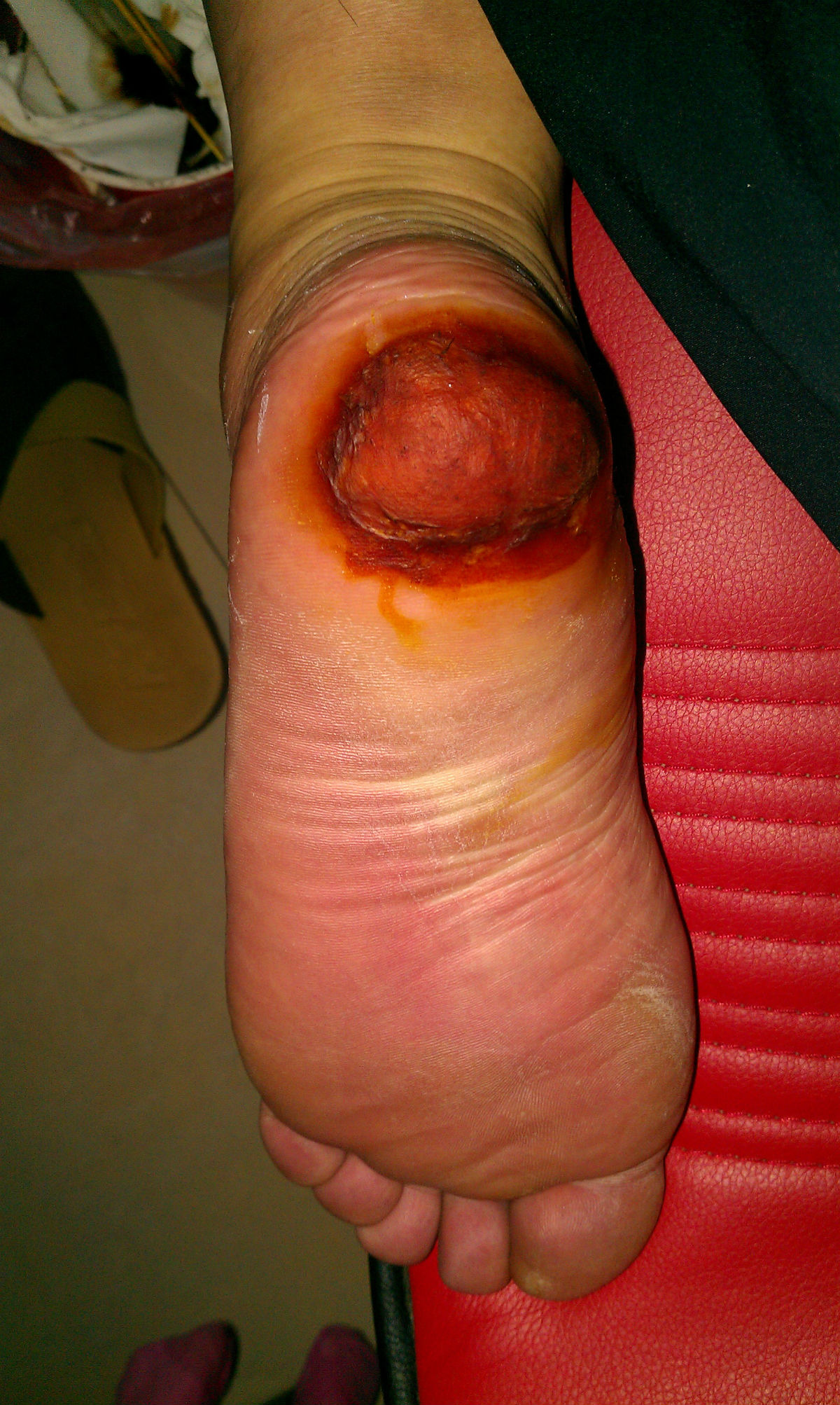 病毒性跖疣图片