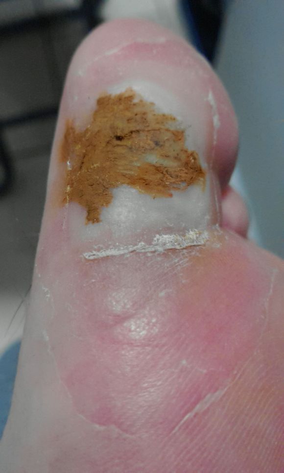 脚趾跖疣初期图片
