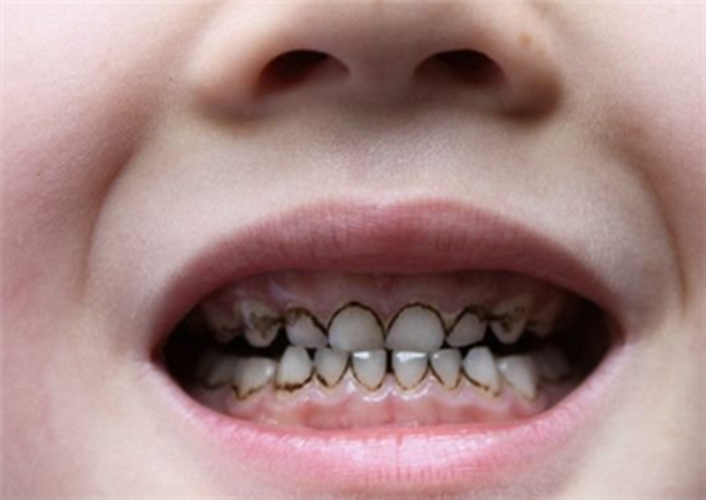 4岁儿童龋齿图片晚期