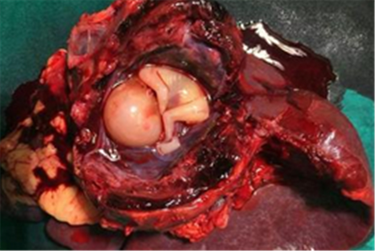 蜕膜组织与孕囊图片图片