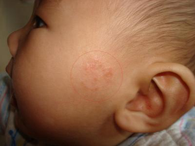 小孩脸部长扁平疣