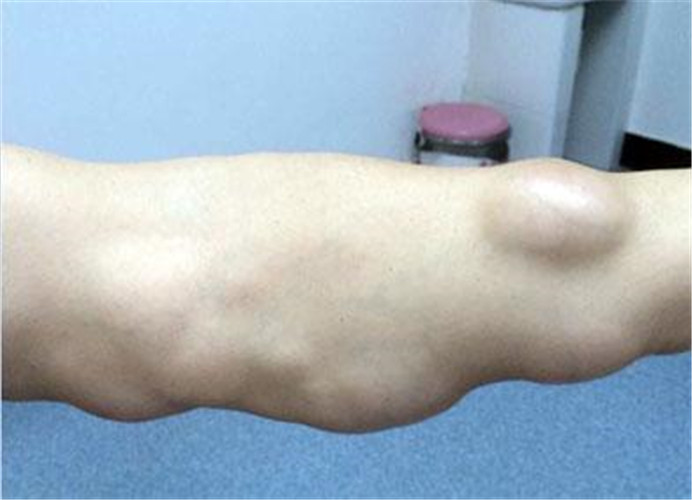 脂肪瘤早期图片 腰部图片