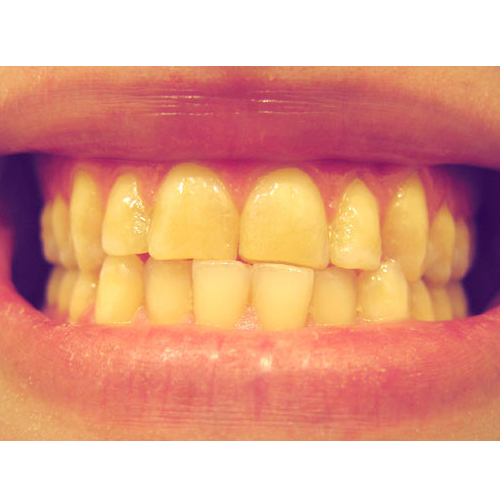 黄牙齿照片图片