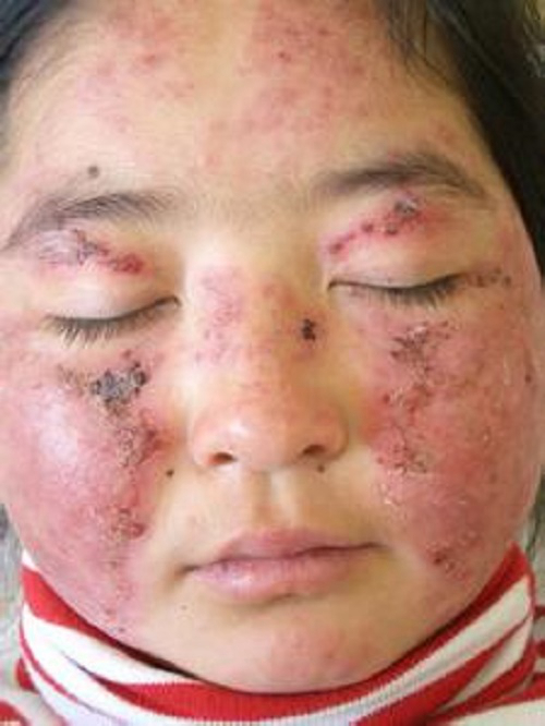 红斑狼疮女孩子脸部症状图片