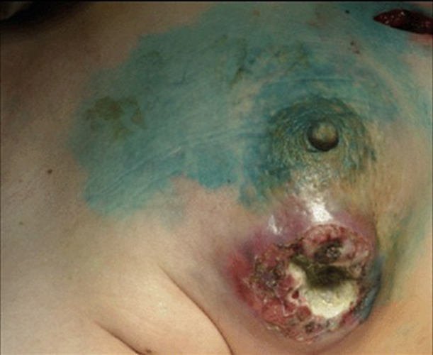 乳癌早期图片