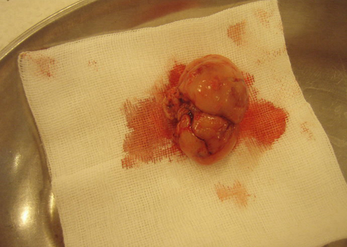 乳腺癌中期手术后肿块图片