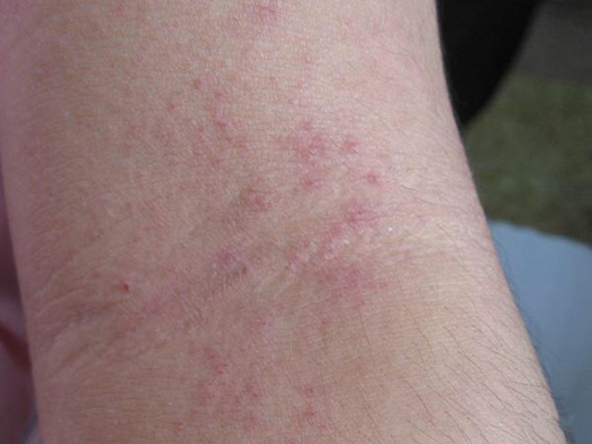 大人腿上起湿疹的现象图片