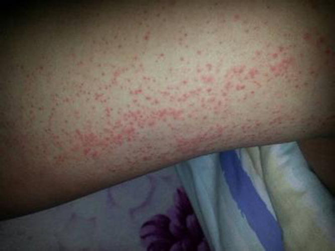 大片扁平疣图片