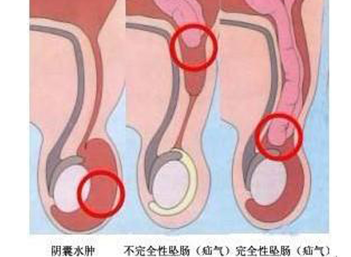 小儿疝气图片