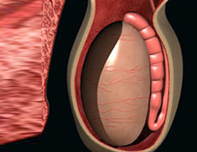 精索静脉曲张的阴囊图图片