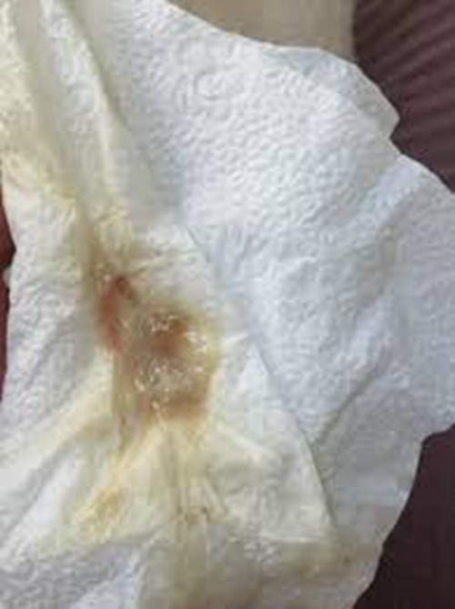 白带异常图片_白带异常症状表现图片大全_有来医生