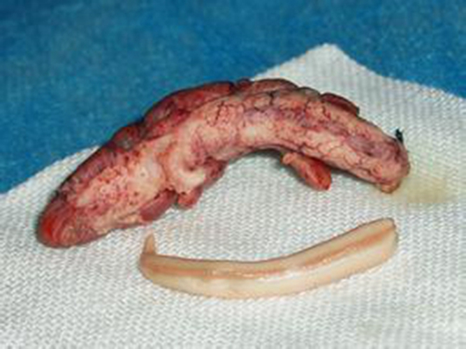烂尾阑尾炎的症状图片图片
