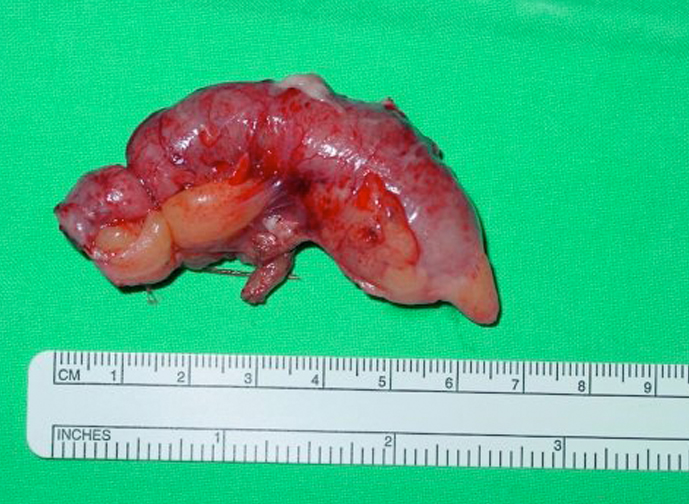 烂尾阑尾炎的症状图片图片