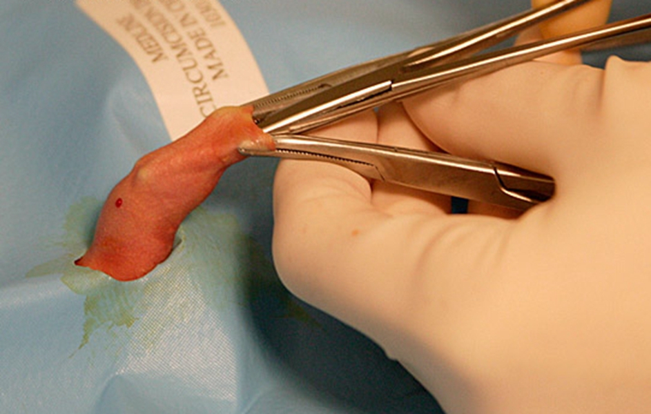 包皮过长手术剥离包皮粘连图片