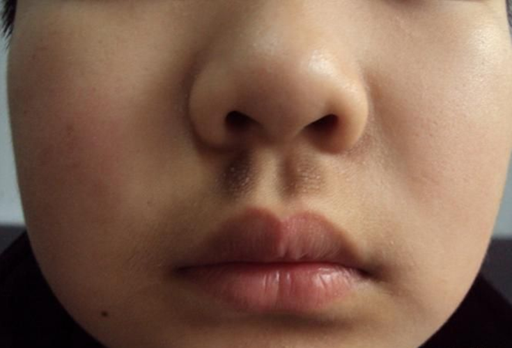 皮肤黑变病图片_皮肤黑变病症状表现图片大全_有来医生