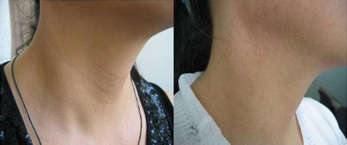 脖子皮肤松弛有颈弛的图片