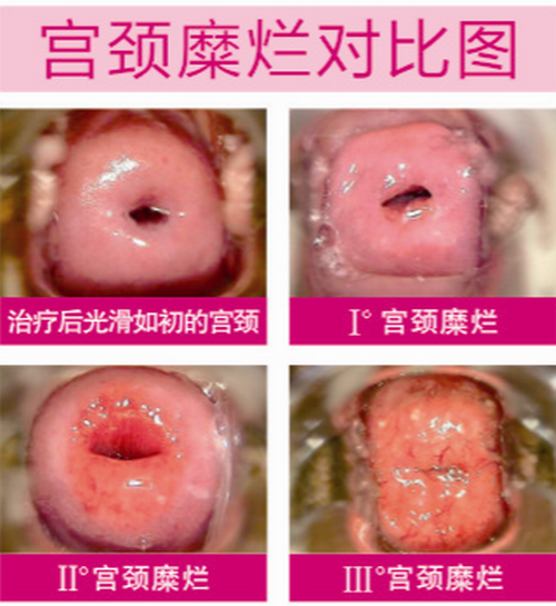宫颈糜烂变化过程图片图片