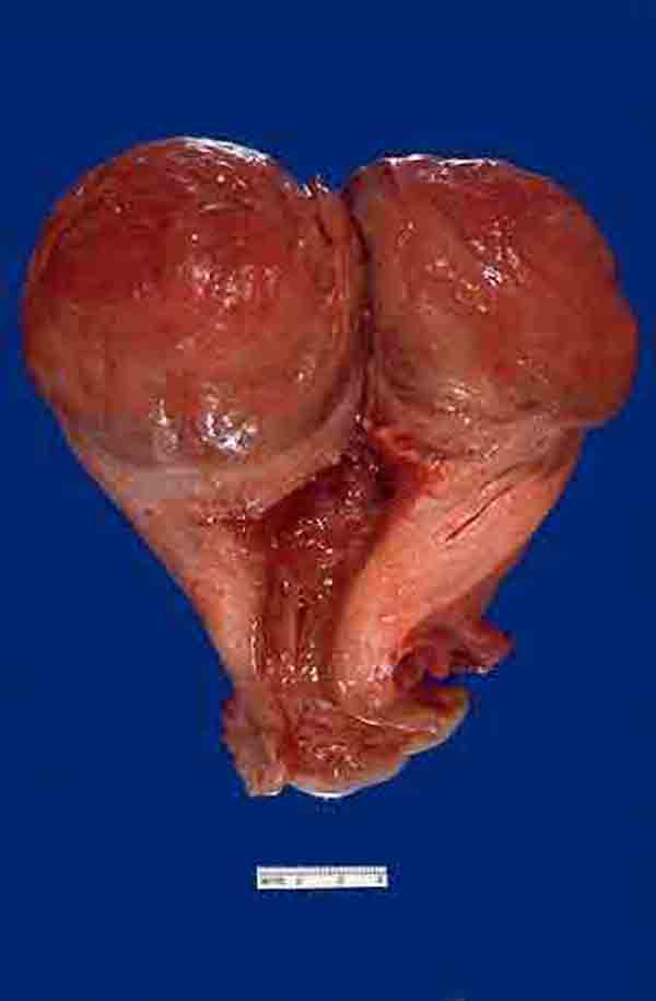 子宫粘膜下肌瘤图片