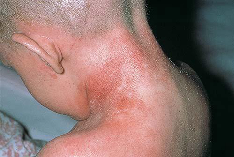 小孩背后有鱼鳞病的图片