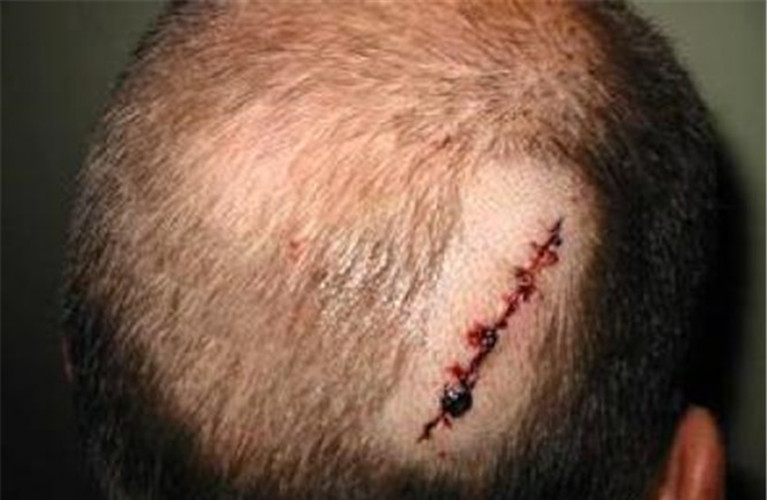 头部脂肪瘤图片 头皮图片