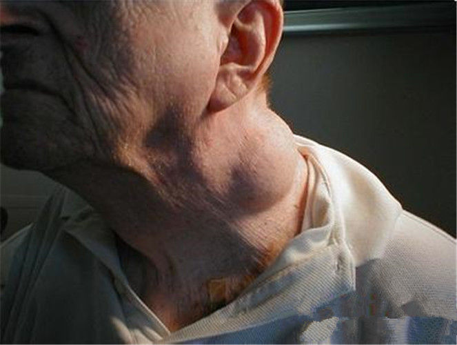 泛发型颈部皮下脂肪瘤图片