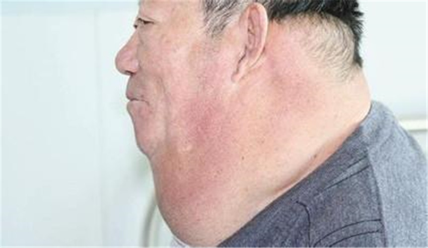 勃子皮下脂肪瘤图片