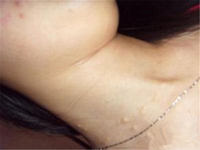 颈部粉瘤图片图片