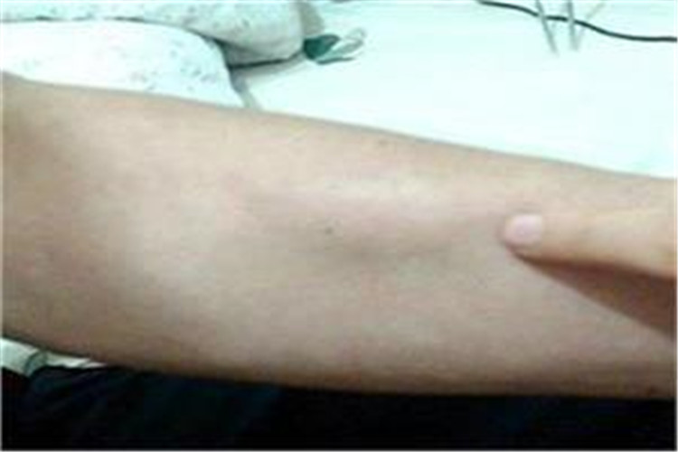 手臂内侧皮下脂肪瘤图片