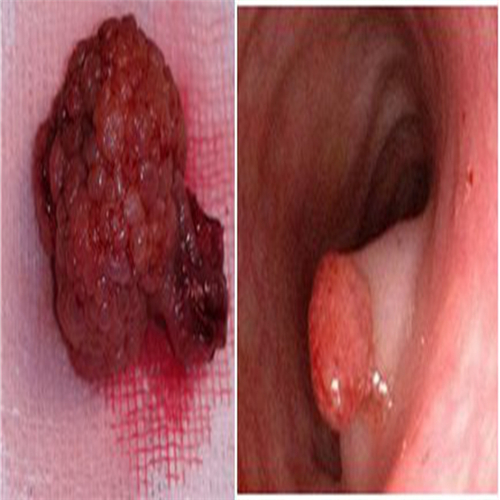 痔疮与直肠息肉图片