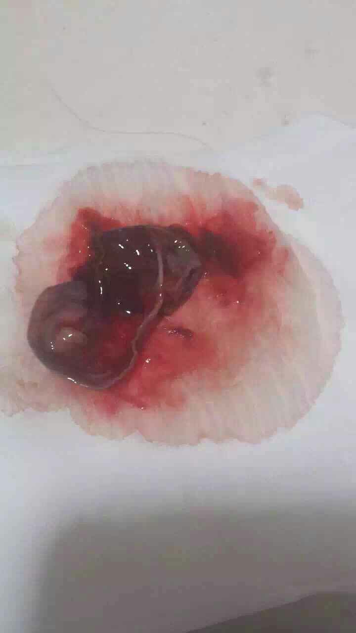 宫颈癌排液的图片图片