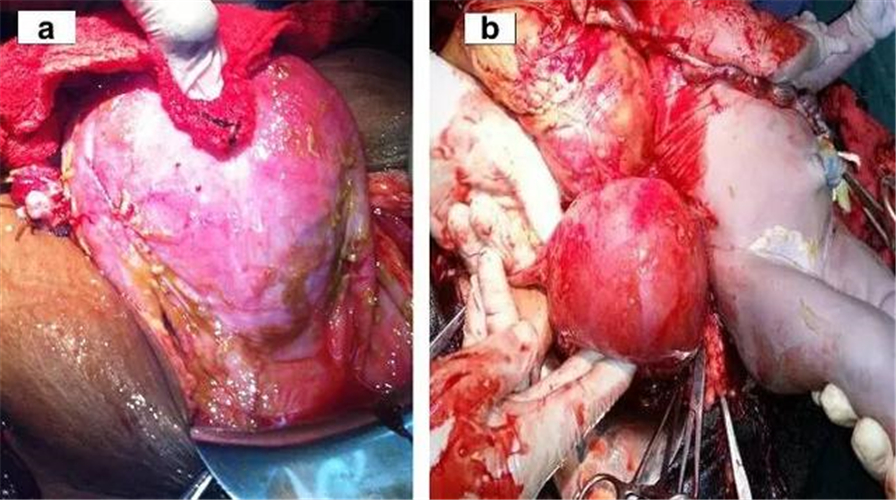 腹腔宫外孕顺利生子图片