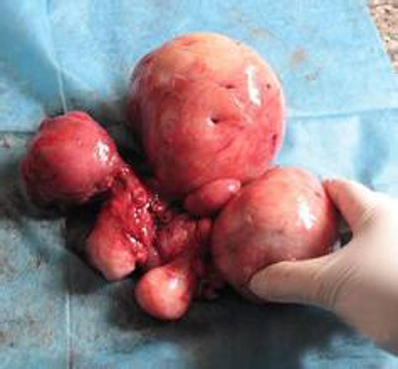 5厘米的子宫肌瘤图片图片