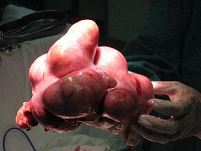 排出子宫肌瘤真实图片图片